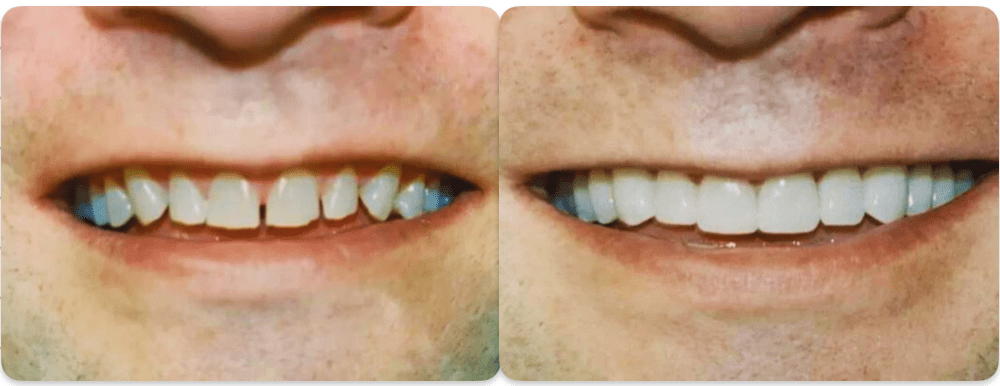 cosmetic smile transformation